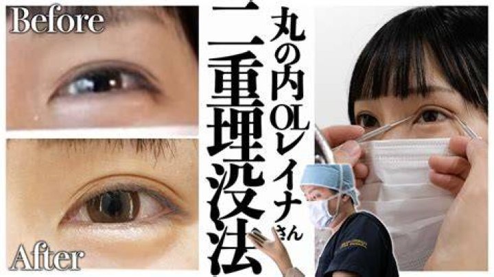 丸の内 レイナ 整形